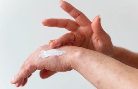 quais-desafios-no-tratamento-de-psoriase-artritica