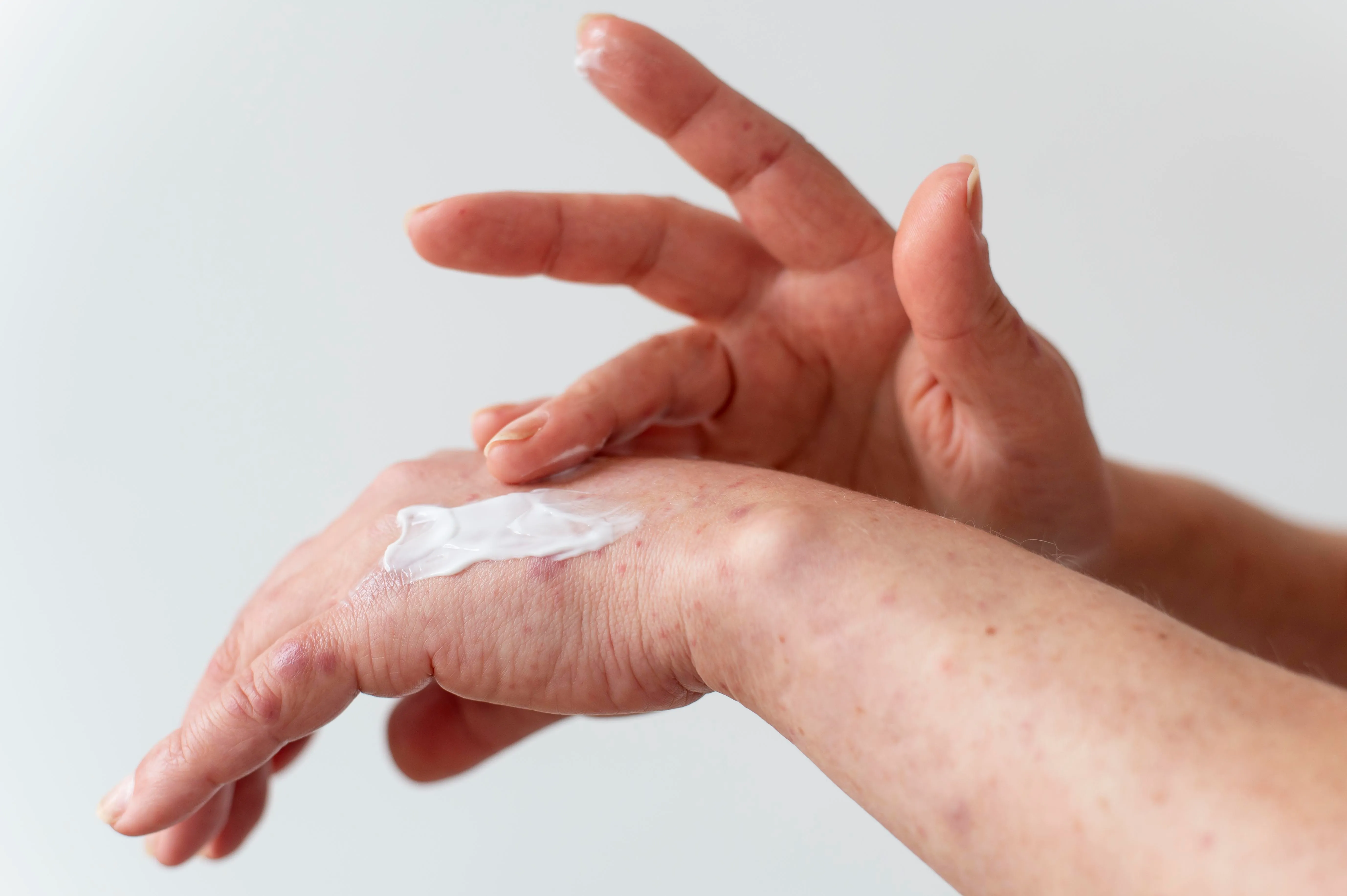 quais-desafios-no-tratamento-de-psoriase-artritica