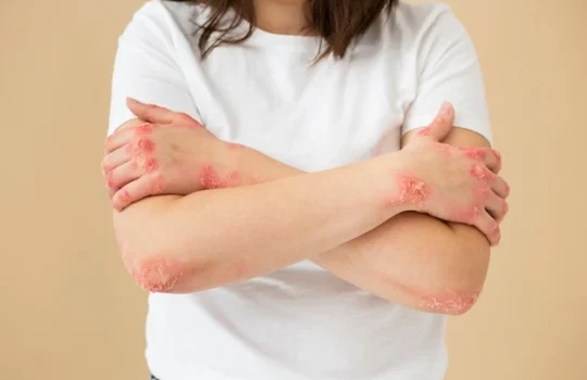 tratamento-para-psoriase