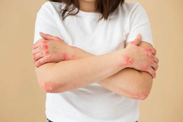 tratamento-para-psoriase
